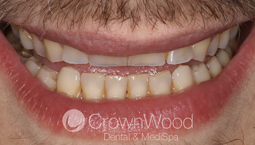 Before 14 ceramic crowns fitted at CrownWood