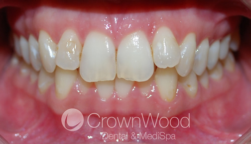 Before Invisalign and Teeth Contouring at CrownWood Dental