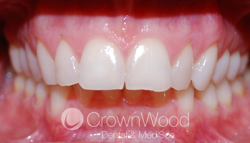 Before Invisalign and Teeth Contouring at CrownWood Dental