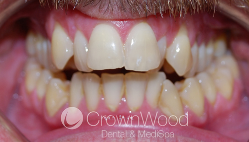 Before Invisalign and Teeth Whitening at CrownWood Dental