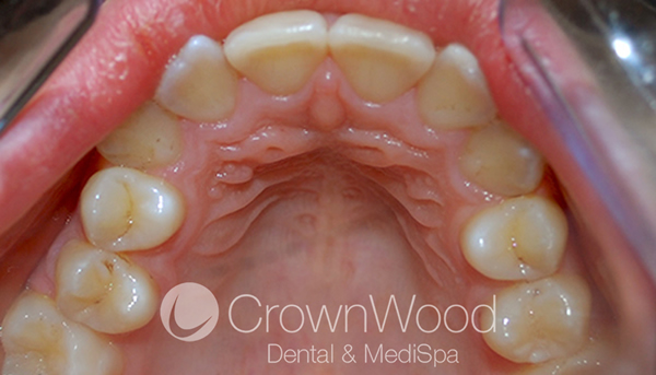 Before Invisalign treatment at CrownWood Dental