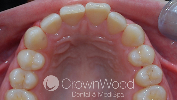 Before Invisalign Full treatment at CrownWood Dental