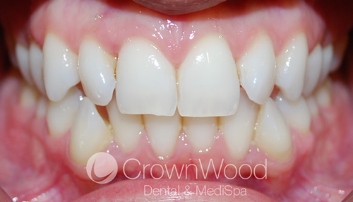 Kylie before Invisalign treatment by Chi at CrownWood Dental