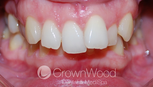 Suzanne before Invisalign and Contouring treatment by Chi at CrownWood Dental