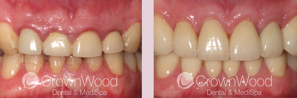 Crown Lengthening Before and After Treatment