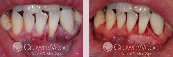Gingival Graft Before and After Treatment