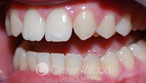 White fillings in Bracknell, Berkshire | 5* Dentist | Great Prices