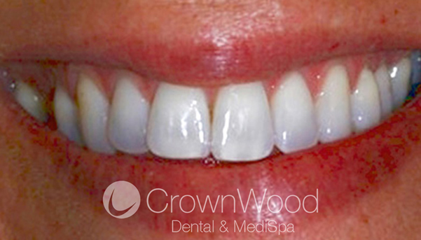 Before & after photos of dental treatments in Bracknell, Berkshire, RG12