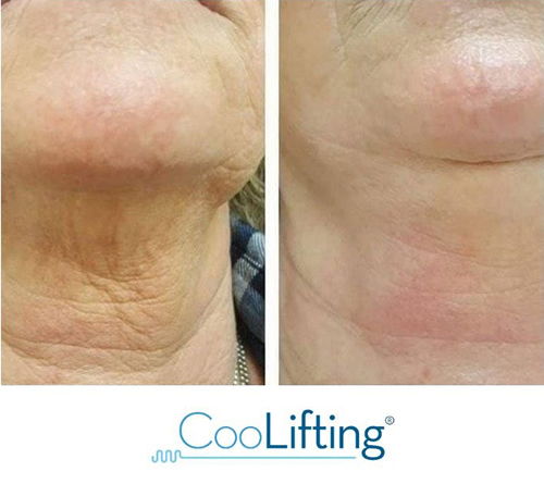 Before and after image showing CooLifting results at CrownWood MediSpa