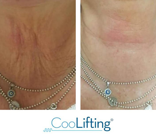 Before and after image showing CooLifting results in Bracknell