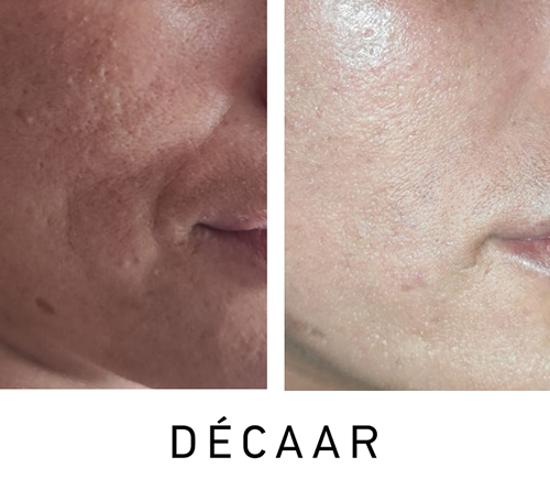 Before and after image showing Decaar Algae Peel results