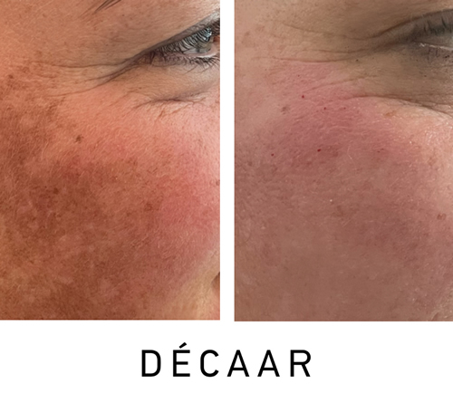 Before and after image showing Decaar Algae Peel results in Bracknell