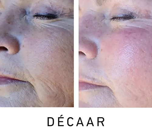 Before and after image showing Decaar Algae Peel results at CrownWood MediSpa