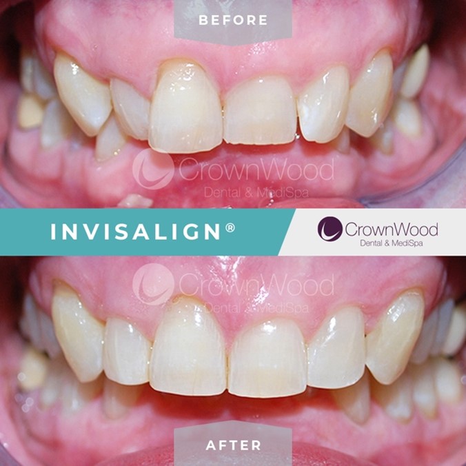 Invisalign Invisible Braces Before & After Photos